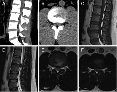 Frontiers Intradural Lumbar Disc Herniation Of L L A Case Report And Literature Review